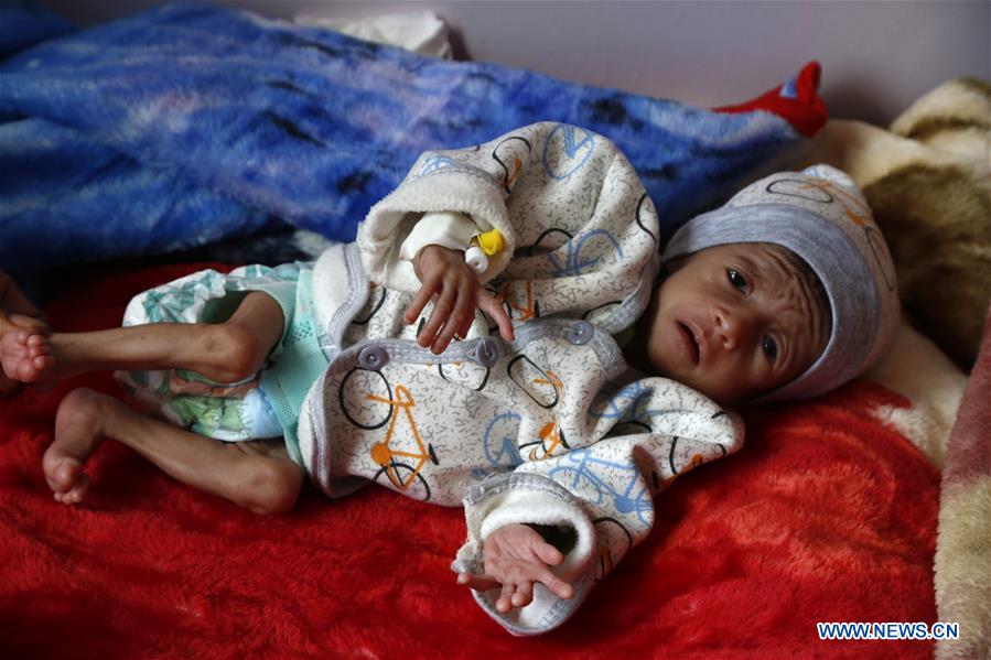 YEMEN-SANAA-CHILDREN-MALNUTRITION